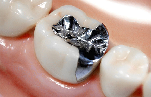 銀歯が持つさまざまな健康リスクとは