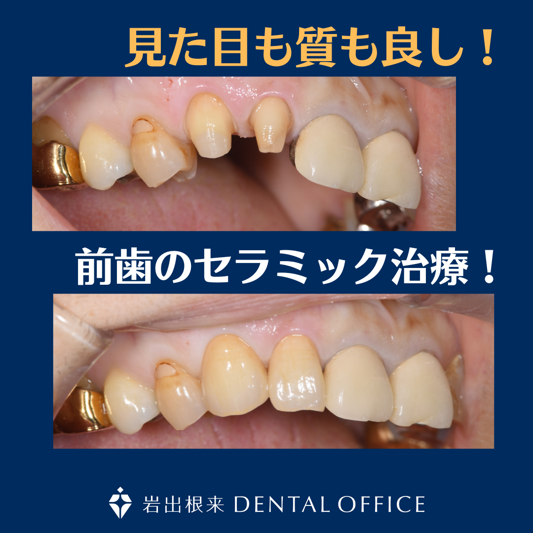 前歯のセラミック治療　審美歯科