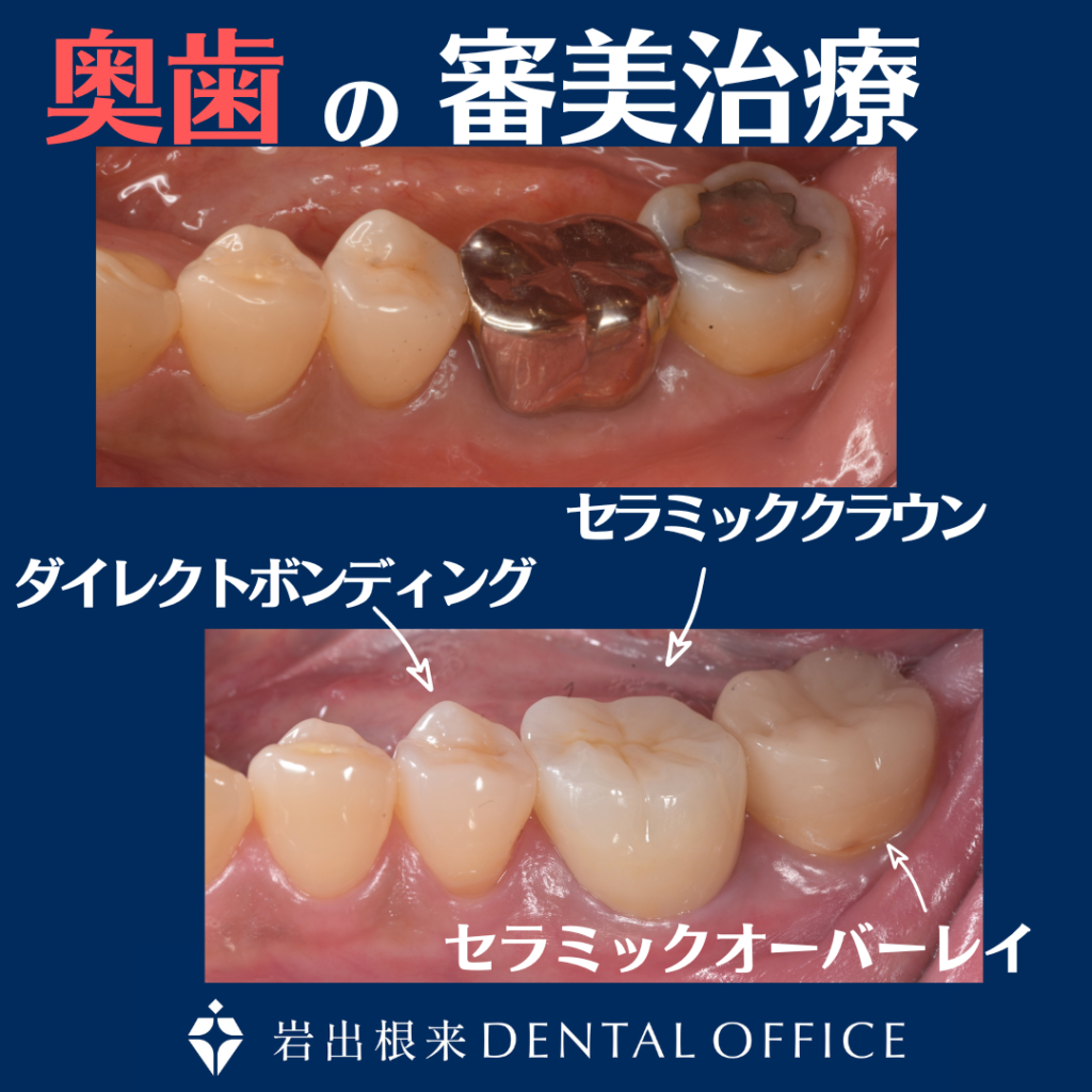 奥歯の歯周病にセラミック治療で対応した例
