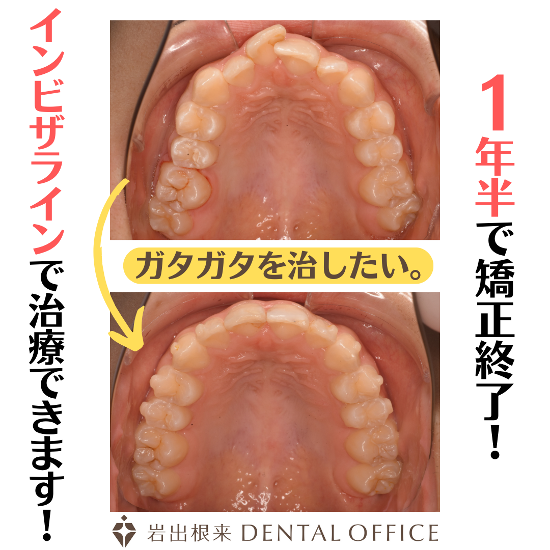 マウスピース矯正　非抜歯でガタガタも治ります。