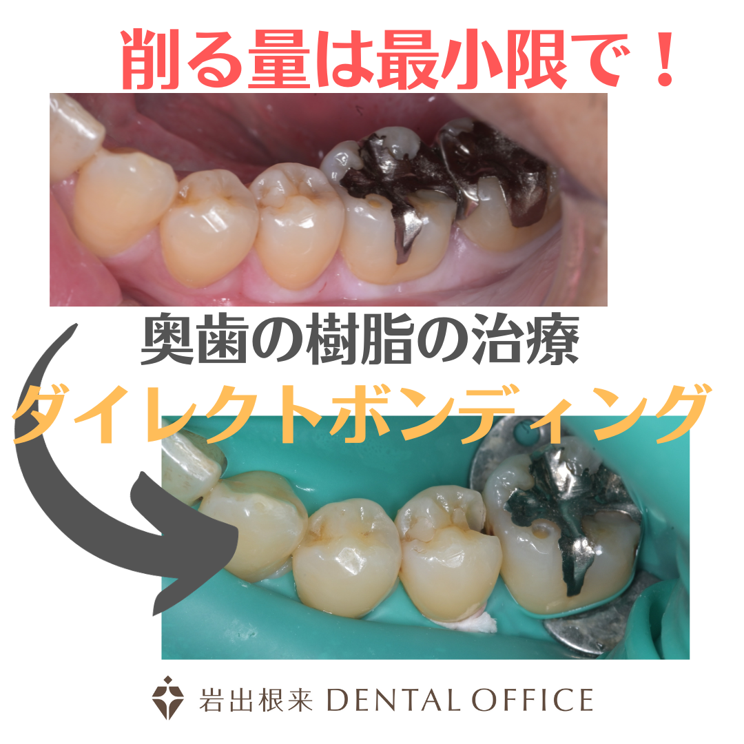 奥歯の審美治療　ダイレクトボンディング