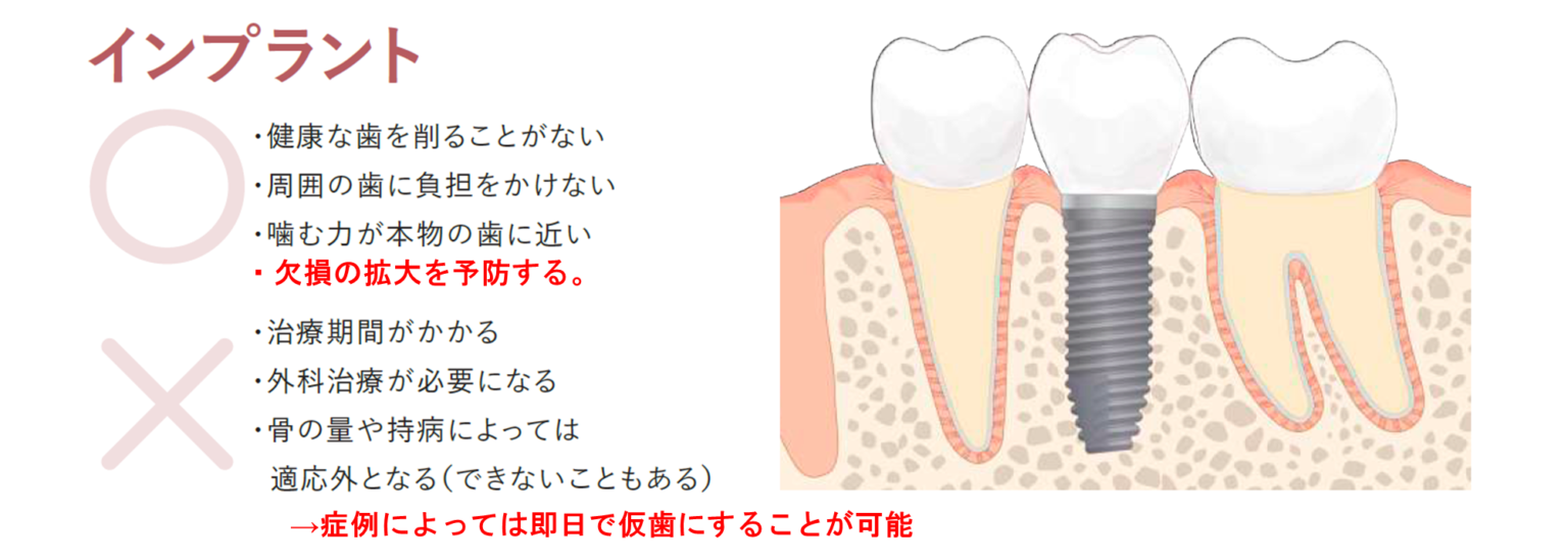 抜歯と診断後　インプラント治療について