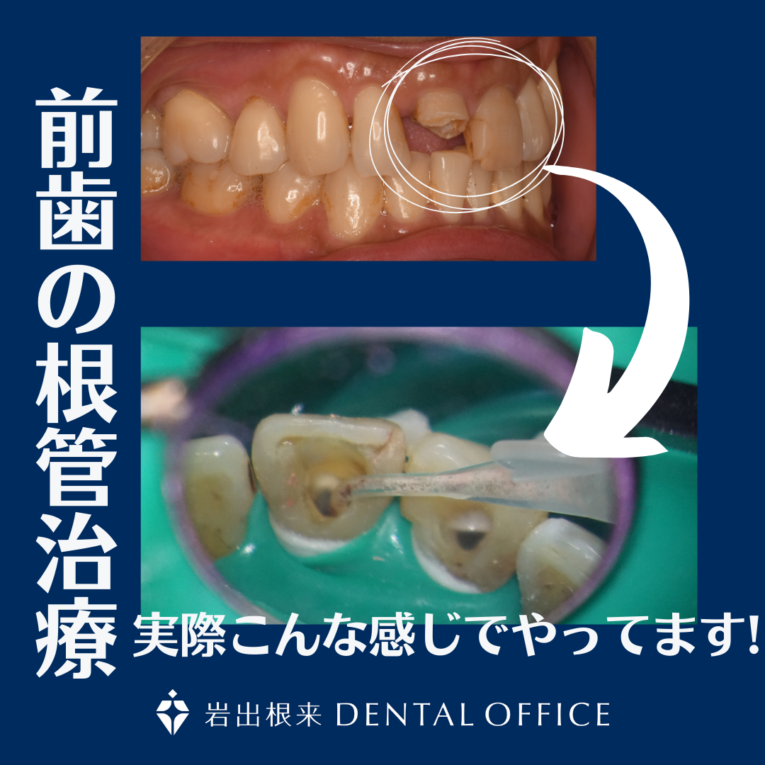 上の前歯の根管治療　マイクロスコープを使用した精密根管治療