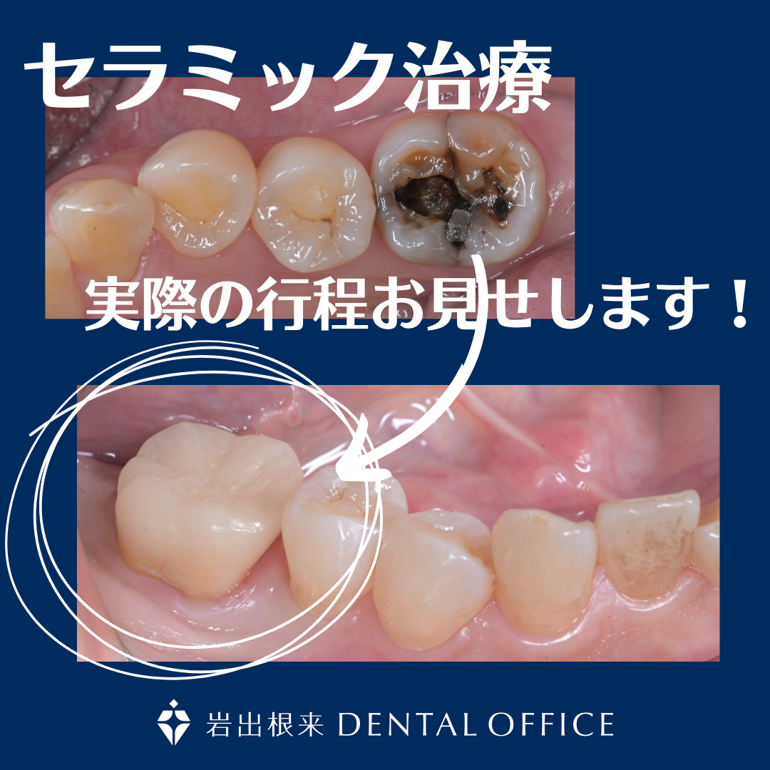 奥歯のセラミック治療　｜和歌山県岩出市の歯科・歯医者