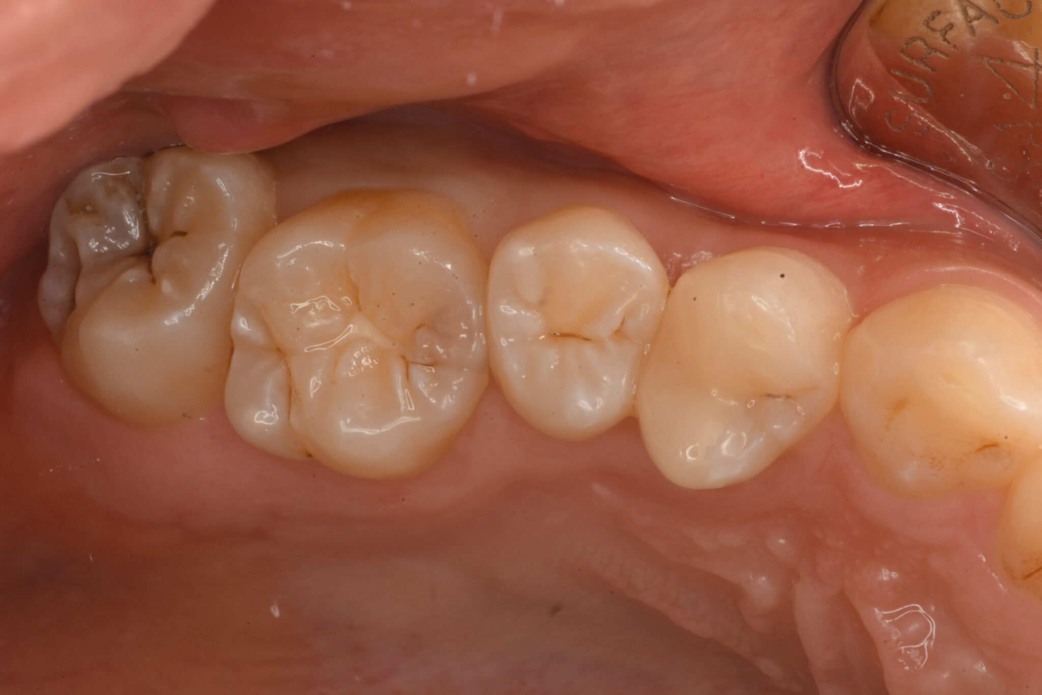 ダイレクトボンディング　初期むし歯の治療例
